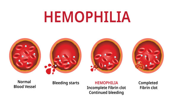 World Haemophilia Day: The Hidden Truth About Women and Haemophilia 2 image 14