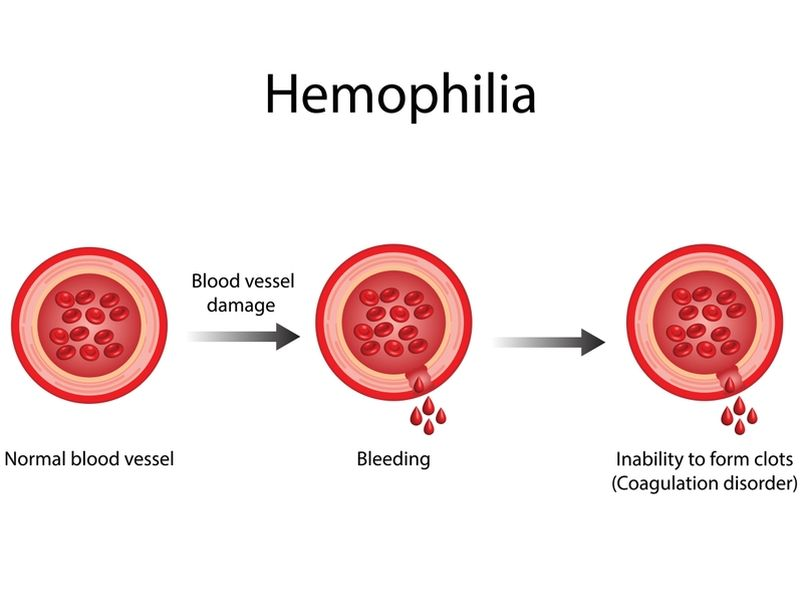 World Haemophilia Day: The Hidden Truth About Women and Haemophilia 1 image 15